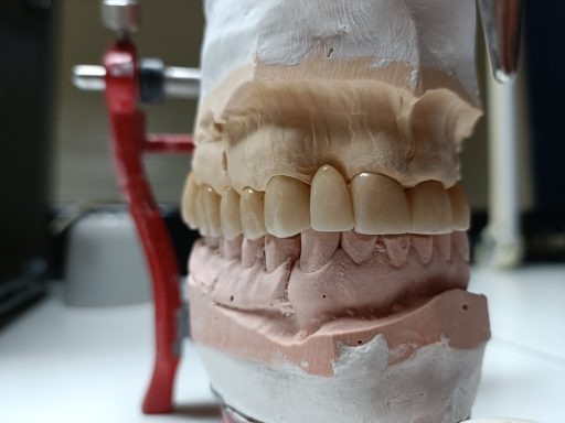 Dentadura en modelo dental