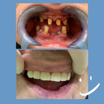 Transformación dental antes y después