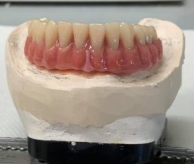 Dentadura en modelo dental