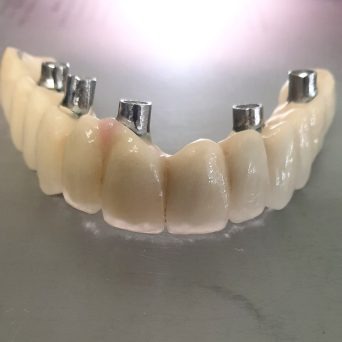 Dentadura con implantes dentales